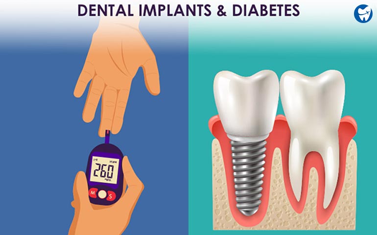 The Ultimate Guide to Dental Implants for People with Diabetes in Dammam