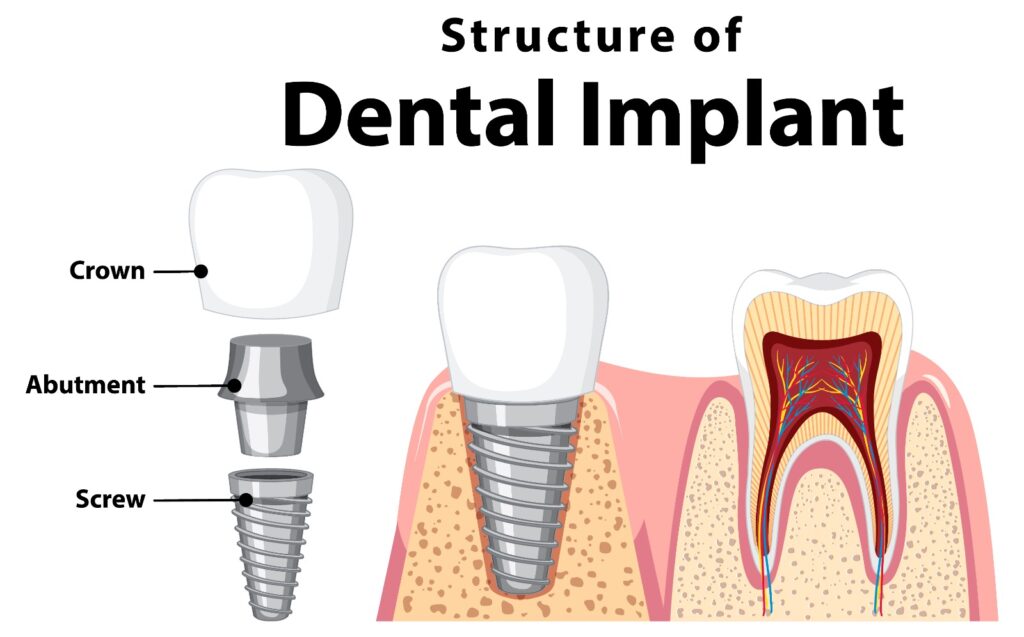 The Comprehensive Guide to Dental Implants in Dammam